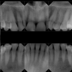 An intraoral full mouth survey contains