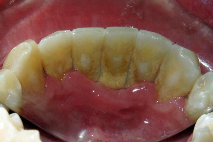 Gums swollen sore disease periodontal